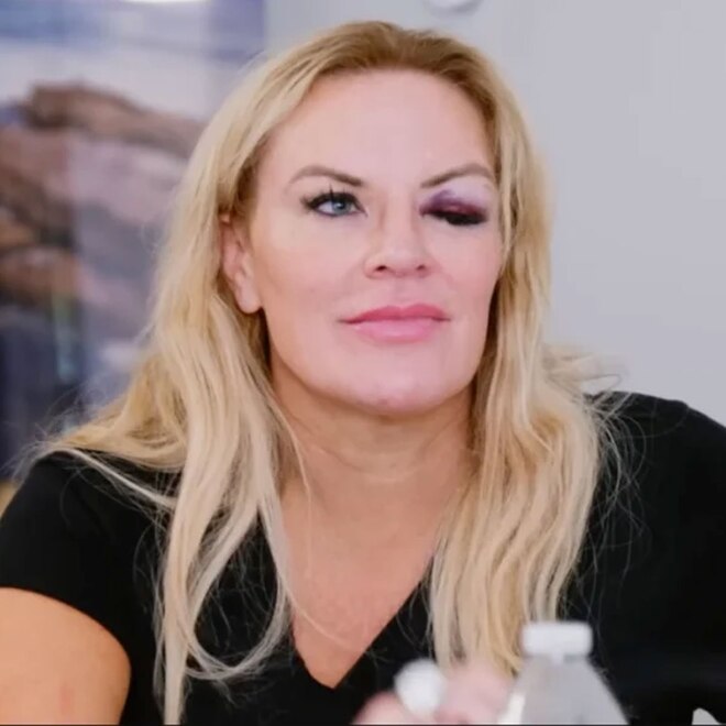 RHOSLC's Heather Gay Shares New Insight About Her Black Eye